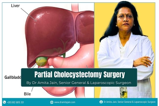 Partial Cholecystectomy Gallbladder Surgeon Dr Amita Jain Partial Cholecystectomy Gallbladder Surgeon Dr Amita Jain